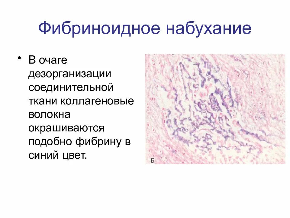 Белковые мезенхимальные дистрофии. Мезенхимальные дистрофии фибриноидное набухание. Мукоидное набухание гистология. Белковые мезенхимальные дистрофии мукоидное набухание. Фибриноидное набухание соединительной ткани препарат.