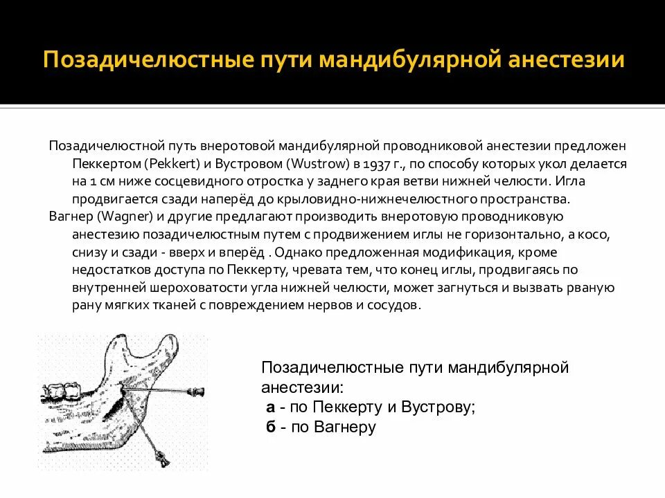 Проводниковая анестезия нижней челюсти мандибулярная. Торусальная анестезия нижней челюсти. Мандибулярная анестезия по Лагарди. Мандибулярная анестезия нижней челюсти. Проведение проводниковой анестезии