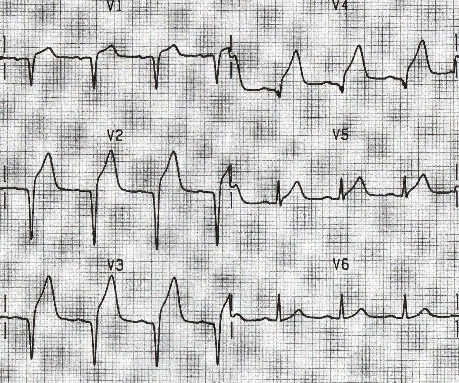 ЭКГ СТЭМИ. STEMI инфаркт миокарда. QRS 37 ЭКГ. Вильсон ЭКГ. Экг со скольки