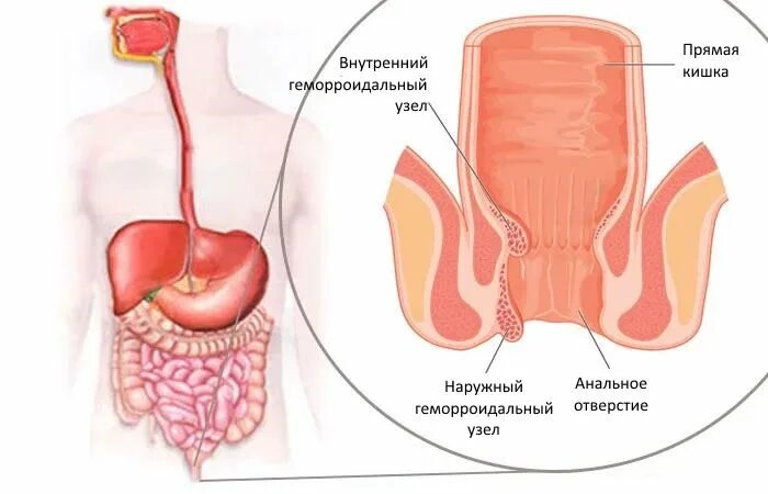 Врач при геморрое у мужчин. Наружный и внутренний геморрой. Иссечение геморроидальных узлов лазером.