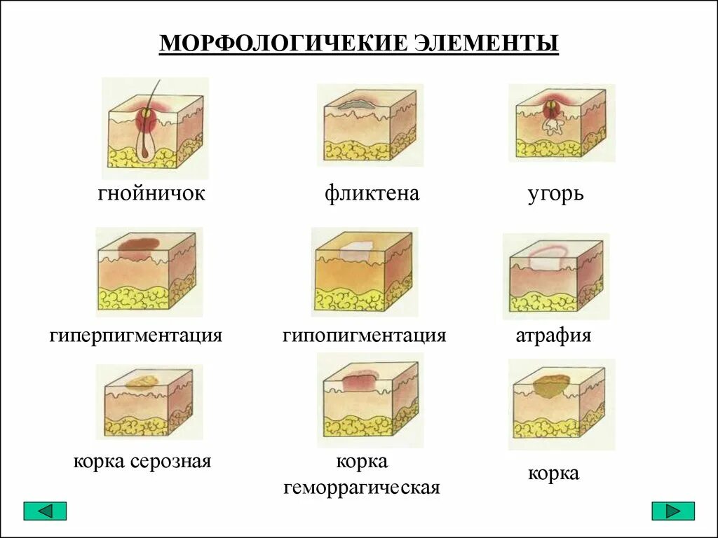 Вторичные элементы поражения