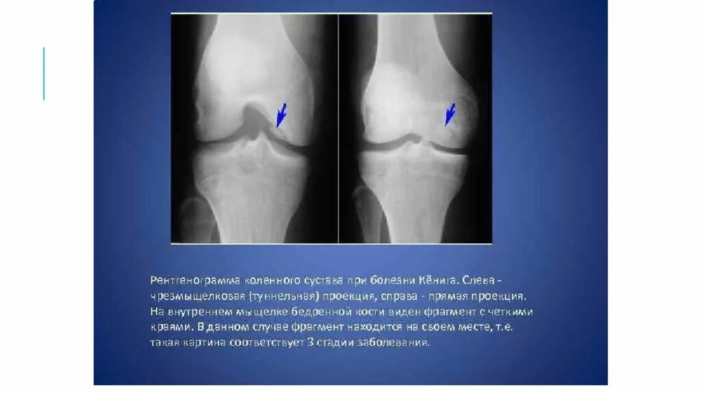 Хондромаляция медиального мыщелка. Болезнь Кёнига рассекающий остеохондрит. Хондромаляция медиального мыщелка бедренной кости - 3-4 ст. Рассекающий остеохондрит надколенника рентген. Остеохондропатия надколенника (болезнь Синдинга-Ларсена).