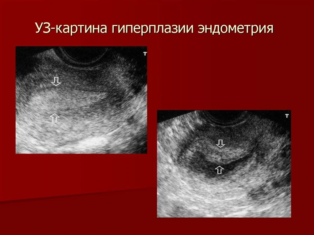 Увеличена эндометрия матки. Гиперплазия эндометрия матки на УЗИ. Эндометрия матки УЗИ гиперплазия эндометрия. Атипическая гиперплазия эндометрия УЗИ. Ультразвуковые критерии гиперплазии эндометрия.