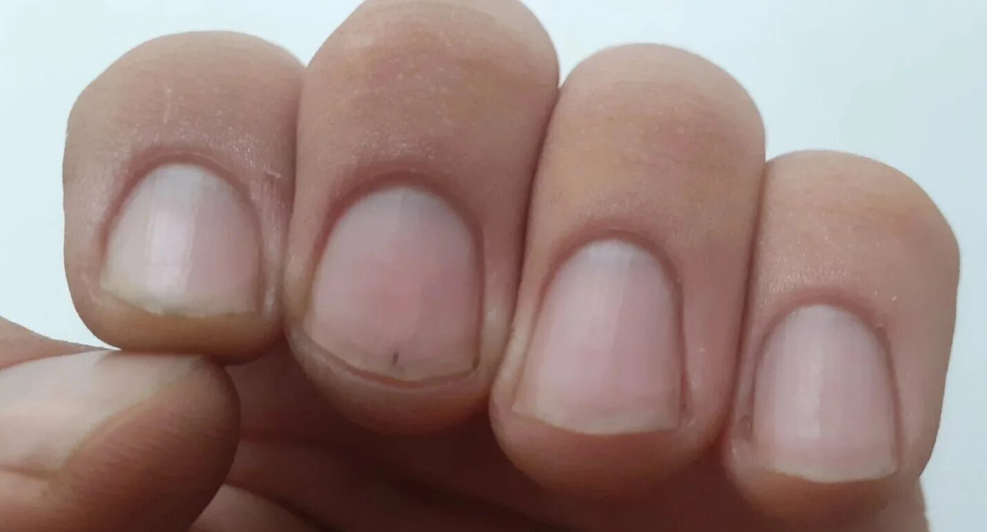 Ногти ребристые вертикально причина у женщин. Продольная меланонихия.