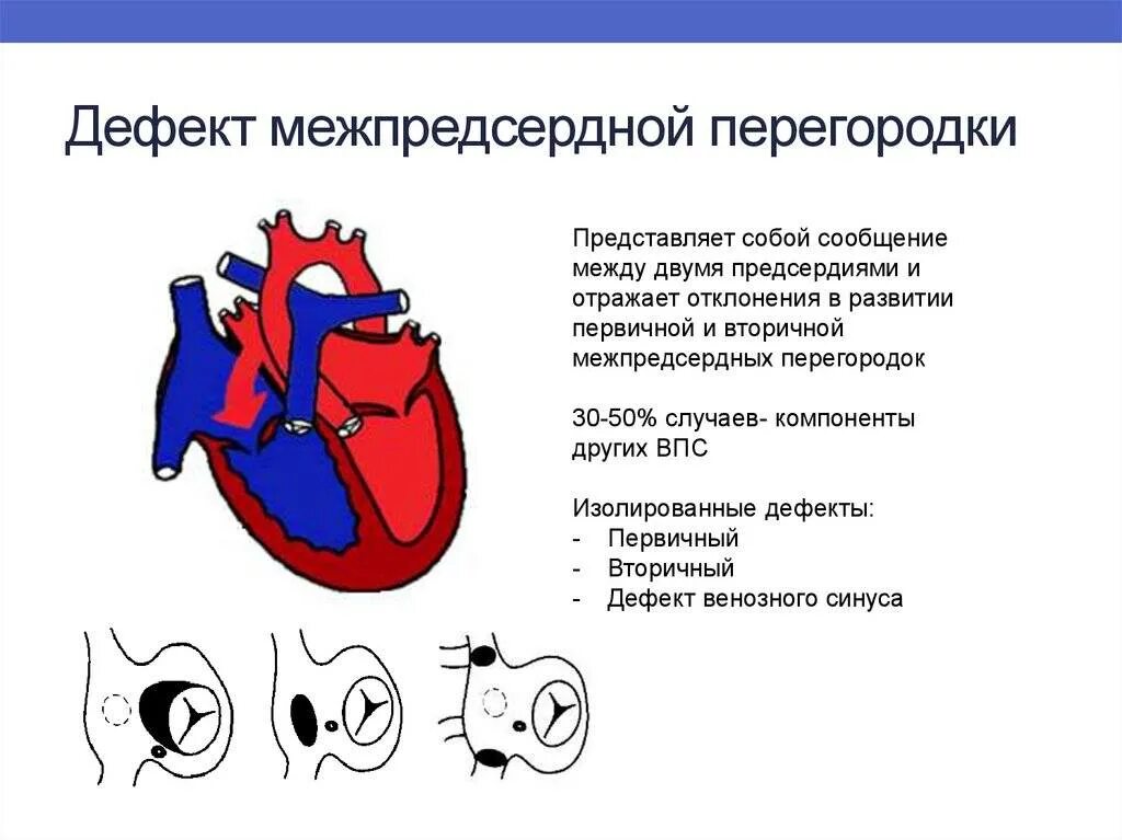 Аневризма перегородки у ребенка. Врожденный порок сердца ДМПП. Врожденный дефект межпредсердной перегородки. Дефект межпредсердной перегородки макропрепарат.