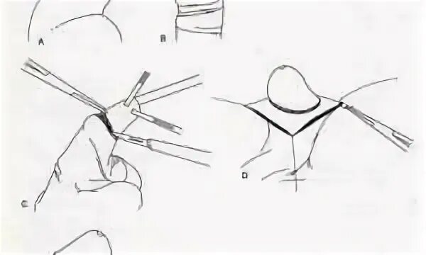 Открытая головка мужчины. Циркумцизио (обрезание крайней плоти) (схема 2). Гипертрофический фимоз.