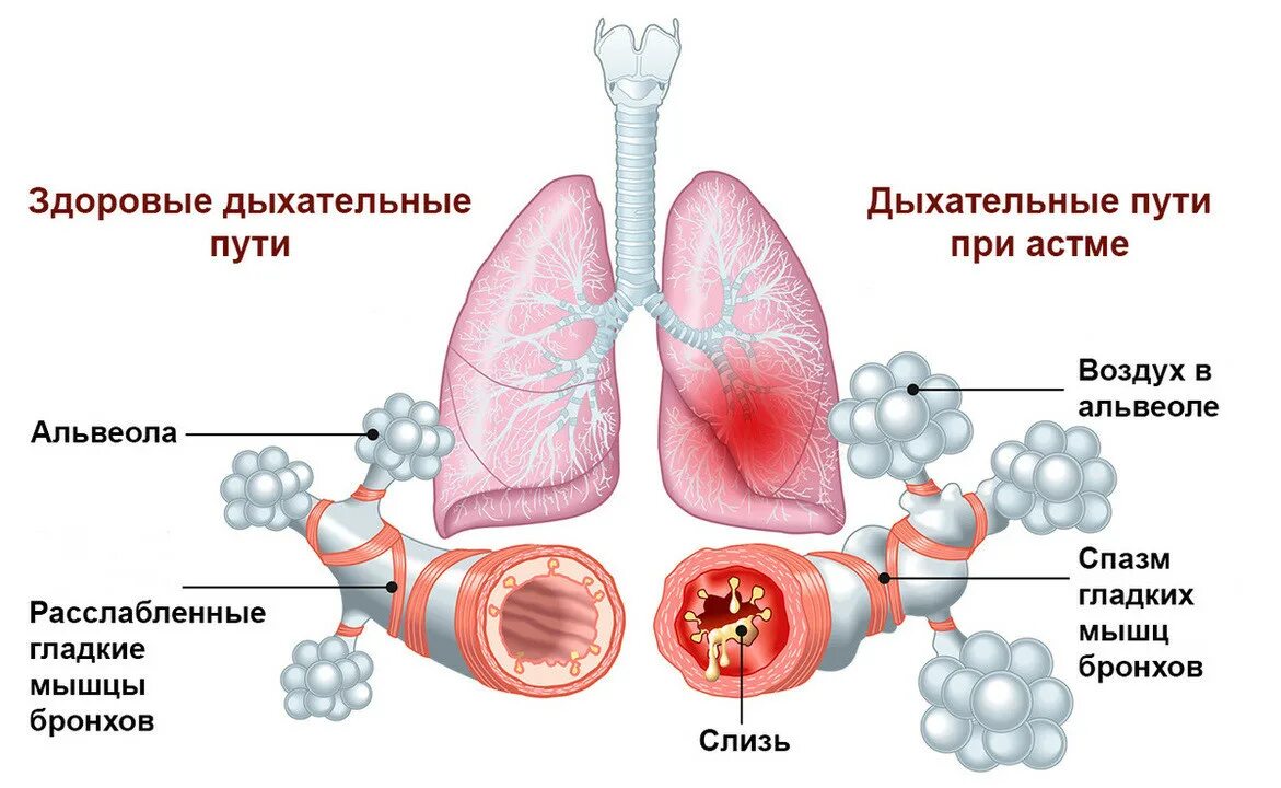 Почему ба. Механизм развития бронхиальной астмы схема. Патогенез аллергической бронхиальной астмы. Патогенез бронхиальной астмы схема. Механизмы развития кашля бронхиальной астмы.