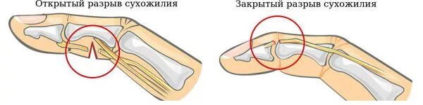 Разрывы отрыва. Отрыв сухожилия разгибателя. Отрыв сухожилия разгибателя пальца. Сухожилие сгибателя пальца. Пластика сухожилия разгибателя пальца.