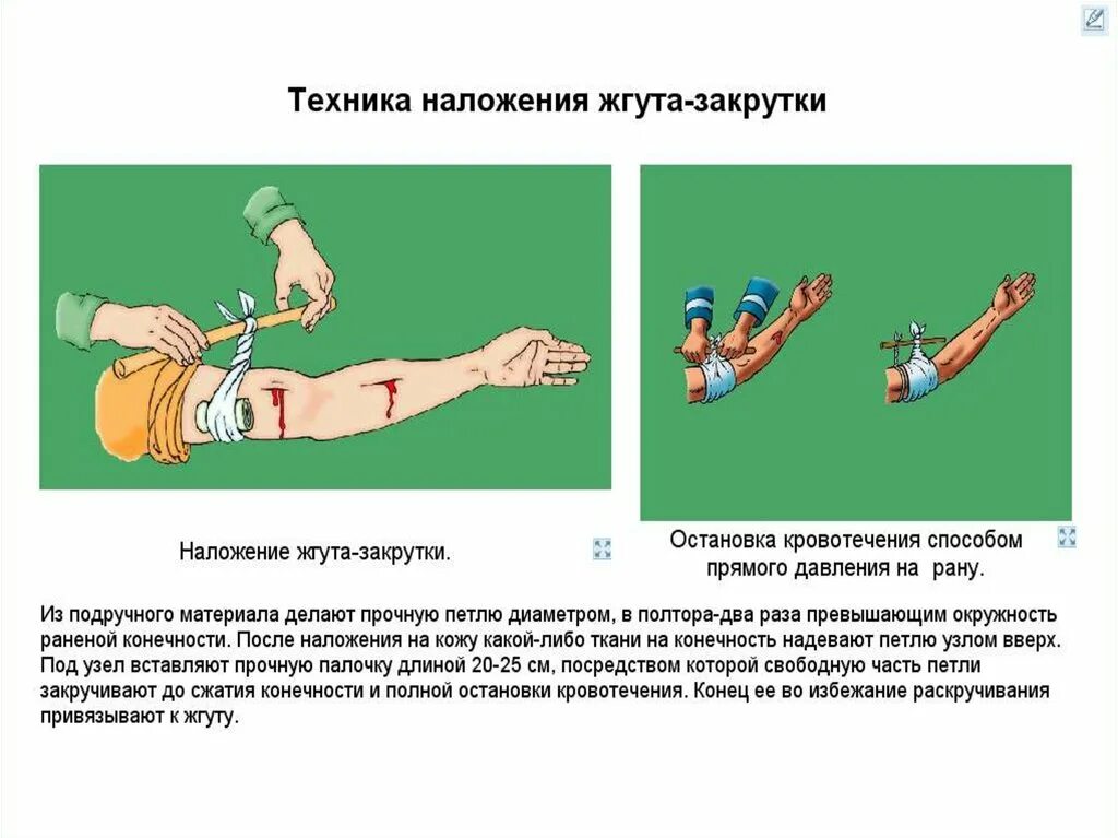 На какое время накладывают артериальный жгут. Первая помощь наложение жгута. Кровотечение наложение жгута. Наложение жгута для остановки кровотечения. Этапы наложения кровоостанавливающего жгута.