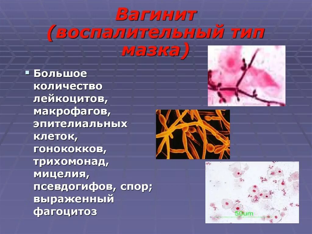 Диагноз вагинит. Воспалительный Тип мазка.