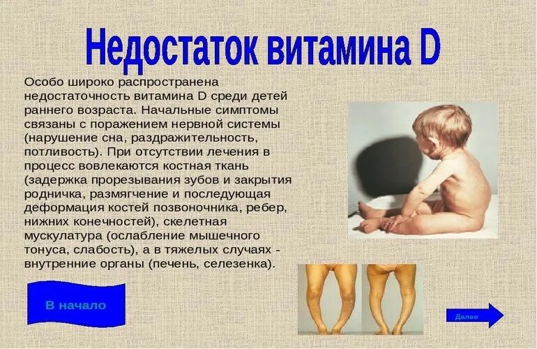 Недостаток витамина д дети рахит. Недостаток витамина д Рафит. Витамин д дефицитный рахит у детей. Недостаток витамина д у детей 6 месяцев. Рахит вызывает недостаток витамина