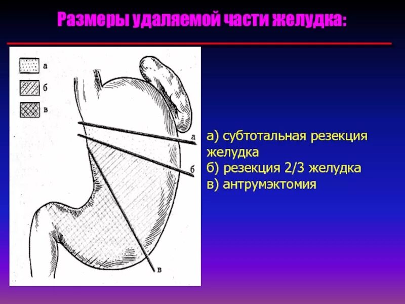 После удаления части желудка. Резекция части желудка. Резекция желудка 2/3 части. Операция по резекции желудка.