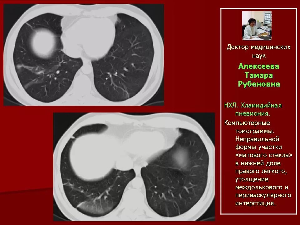 Хламидийная пневмония кт. Микоплазменная пневмония на кт легких. Пневмония на кт.