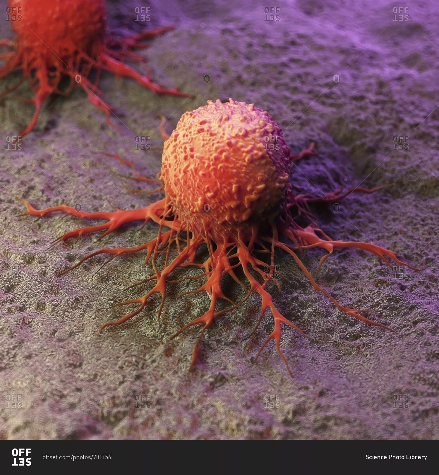 Клетки раковой опухоли. Женская раковая клетка. Женская раковая клетка. Опухоль под микроскопом. Женская раковая клетка.