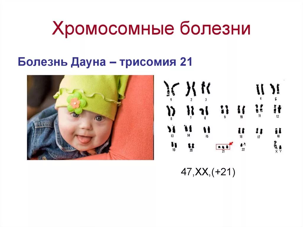 Сколько хромосом у людей с синдромом дауна. Синдром Дауна трисомия 21 хромосомы. Болезнь Дауна трисомия 21. Болезнь Дауна трисомия. Синдром Дауна трисомия 21.