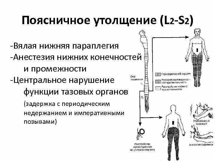 Синдром поражения поясничного утолщения. Синдром поражения шейного утолщения спинного мозга. Поражение поясничного утолщения спинного мозга. Симптомы поражения поясничного утолщения.