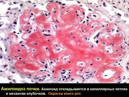 Амилоидоз миокарда