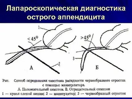 После операции аппендицита держится температура