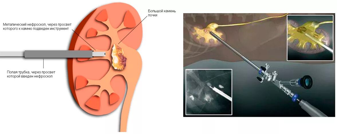Что делать если камень застрял в мочеточнике. Трансуретральная литотрипсия камней почек. Лазерная контактная литотрипсия камня мочеточника. Контактная трансуретральная литотрипсия и литоэкстракция. Эндоскопическая контактная литотрипсия.