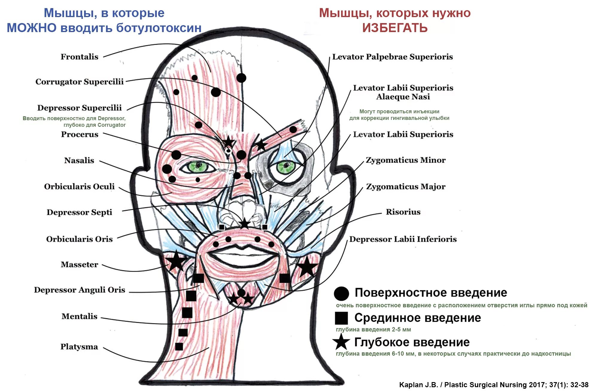 Точки ботулотоксина укола схема. Точки введения диспорта схема. Схема мышц лица ботулотоксин. Глубина введения ботокса в лицо. Точка уколова