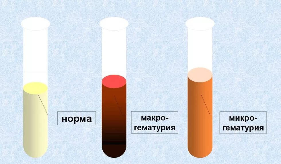 Моча у мужчин. Макрогематурия и микрогематурия. Гемоглобинурия. Цвет мочи при макрогематурии.