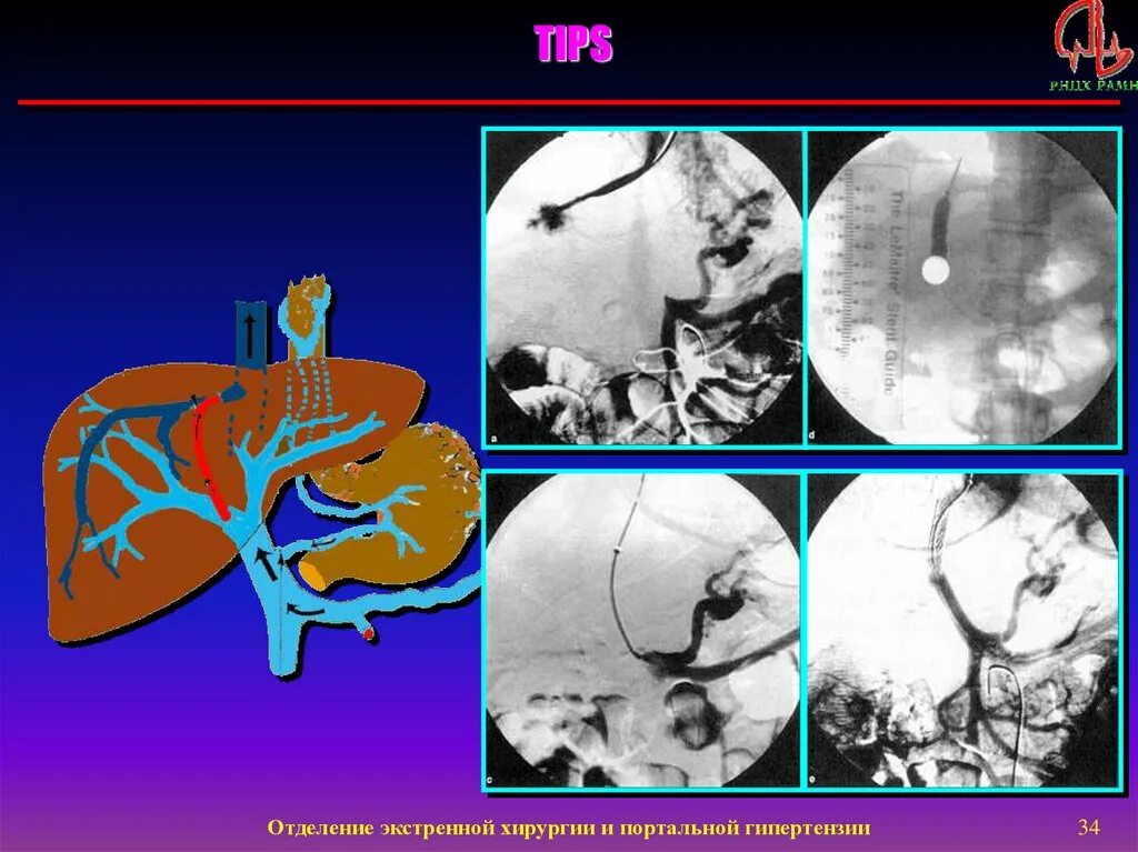 Операция гипертония. Портальная гипертензия портокавальные анастомозы. Портальная гипертензия Пациора. Портальная гипертензия операция. Операции при портальной гипертензии.