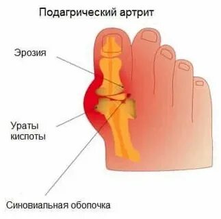 Острый подагрический артрит