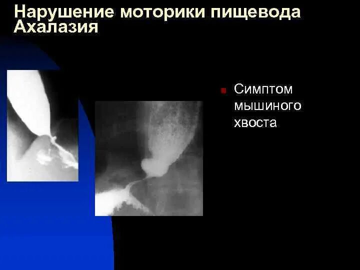 Доброкачественное новообразование пищевода. Нарушение моторики пищевода. Особенности моторики пищевода. Нарушение моторики пищевода. Гипермоторная дискинезия пищевода.