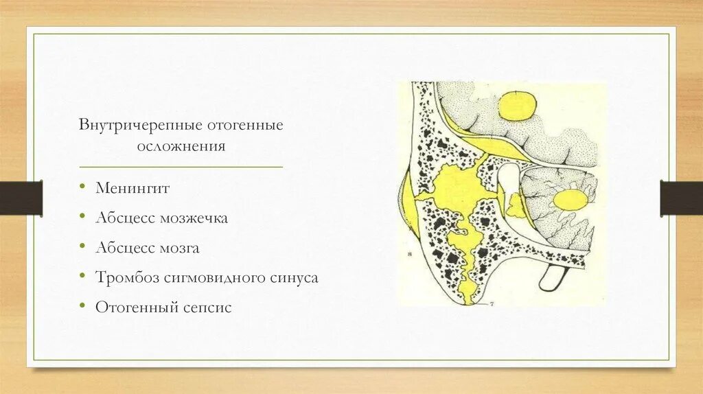 Отогенные осложнения. Отогенные внутричерепные осложнения. Отточенные внутричерепные осложнения.. Отогенный менингит осложнения. Отогенные внутричерепные абсцессы.