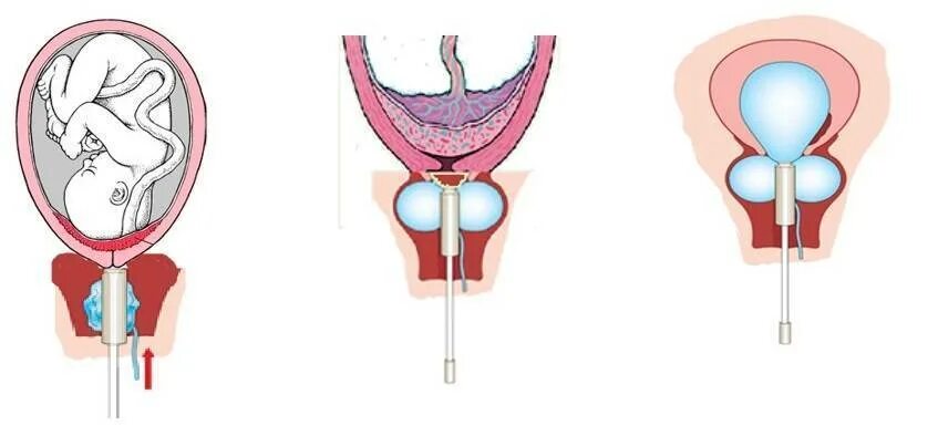 Катетер фолея в цервикальном канале. Стимуляция матки для родов катетером фолея. Катетер фолея для стимуляции родов. Что такое катетер фолея для беременных. Балонный катетер для стимуляции родовой.