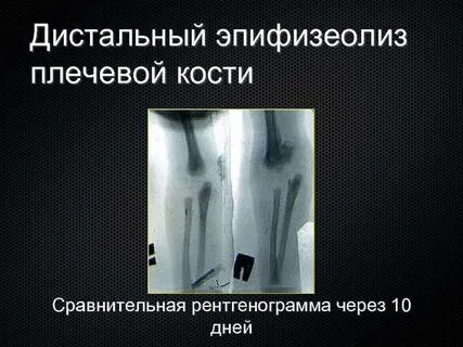 Дистальный эпифизеолиз