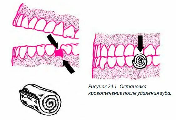 Остановить кровотечение удаления зуба. Остановка кровотечения из лунки удаленного зуба. Кровотечение после удаления зуба. Способы остановки кровотечения из лунки удаленного зуба.
