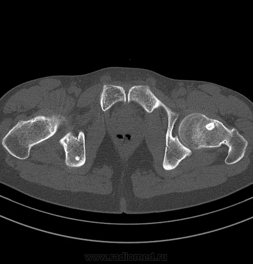Кт подвздошной кости. Эностоз костный островок. Остеоид остеома подвздошной кости на кт. Остеома костей таза кт. Эностоз кт.