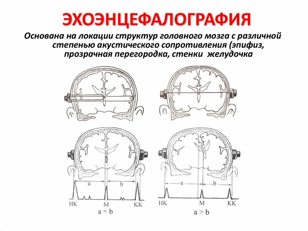 Эхоэнцефалография метод диагностики. Эхо ЭГ при геморрагическом инсульте. М-Эхо срединных структур головного мозга. Эхо ЭГ показатели нормы. Эг что это за обследование