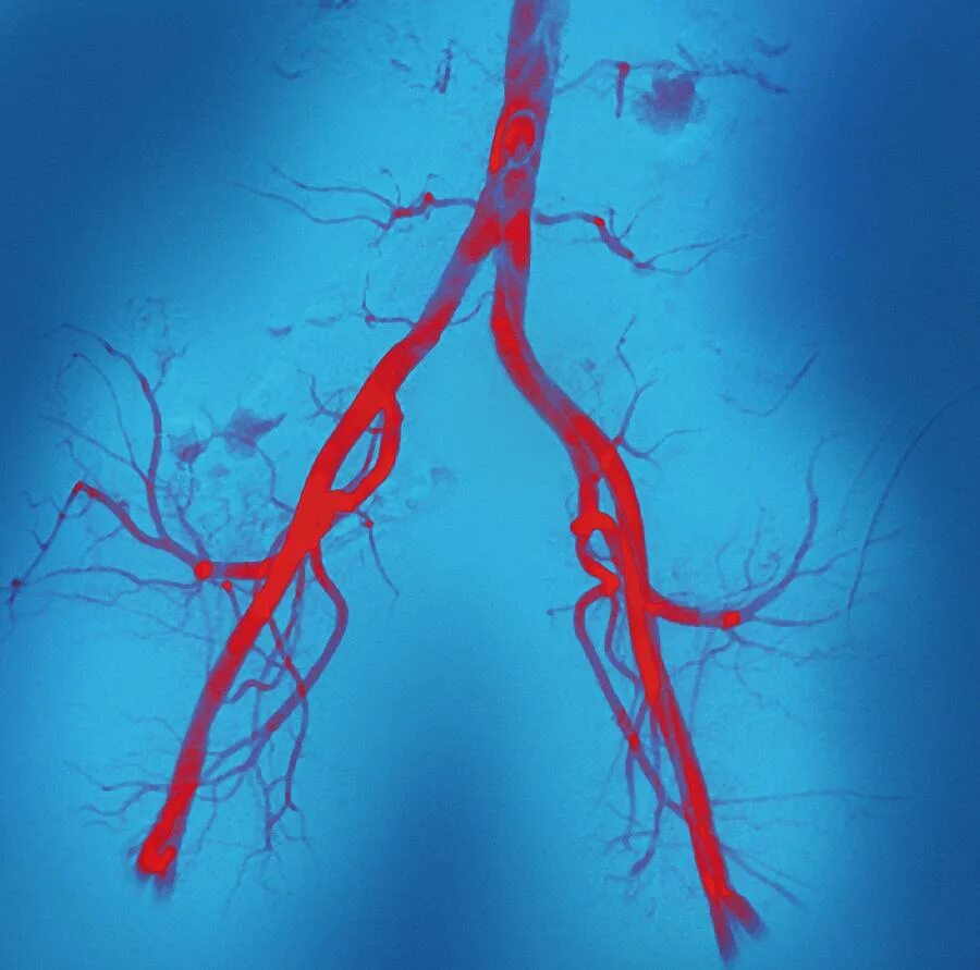 Аорты нижних конечностей. Ангиография артерий нижних конечностей (АНК). Артерии фон. Кровеносные сосуды в виде дерева.