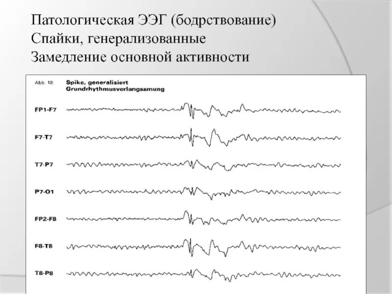 Ээг кемерово. Патологическая ЭЭГ бодрствование. Направление на ЭЭГ. Генерализованная активность на ЭЭГ. Фокус патологической активности на ЭЭГ.