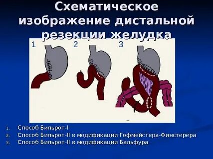 Бильрот 2 в модификации