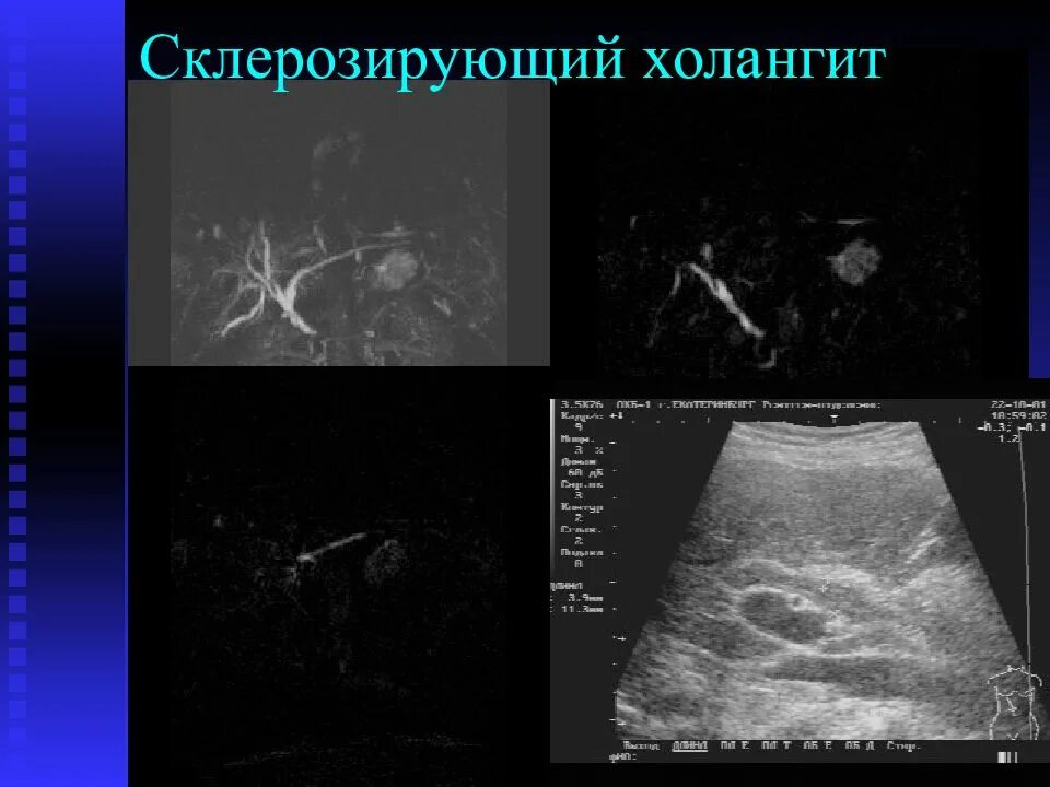 Эхопризнаки желчного пузыря. Первичный билиарный холангит УЗИ. Первичный склерозирующий холангит кт.