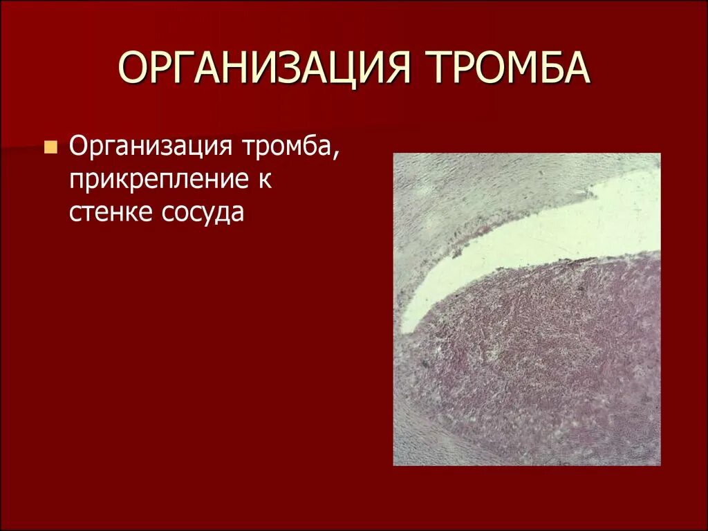 Тромб с явлениями организации. Смешанный тромб с началом организации. Организация тромба