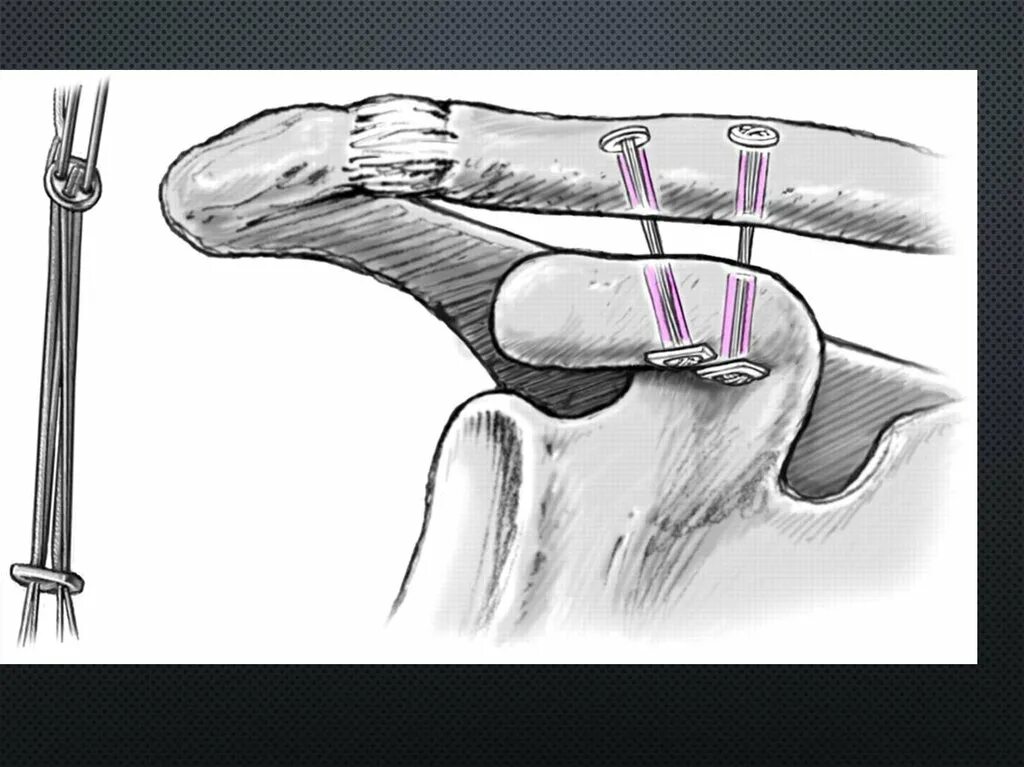 Разрыв сочленений. Разрыв акс операция с пластиной. Акромиально-ключичный сустав разрыв. Лавсанопластика ключично-акромиального сочленения операция.