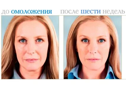 Фотодинамическая терапия лица