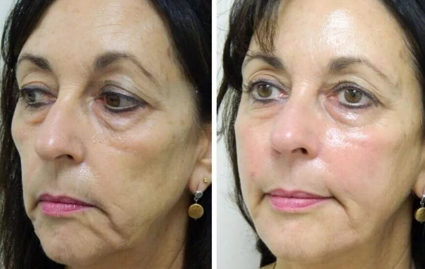 онемение лица после операции