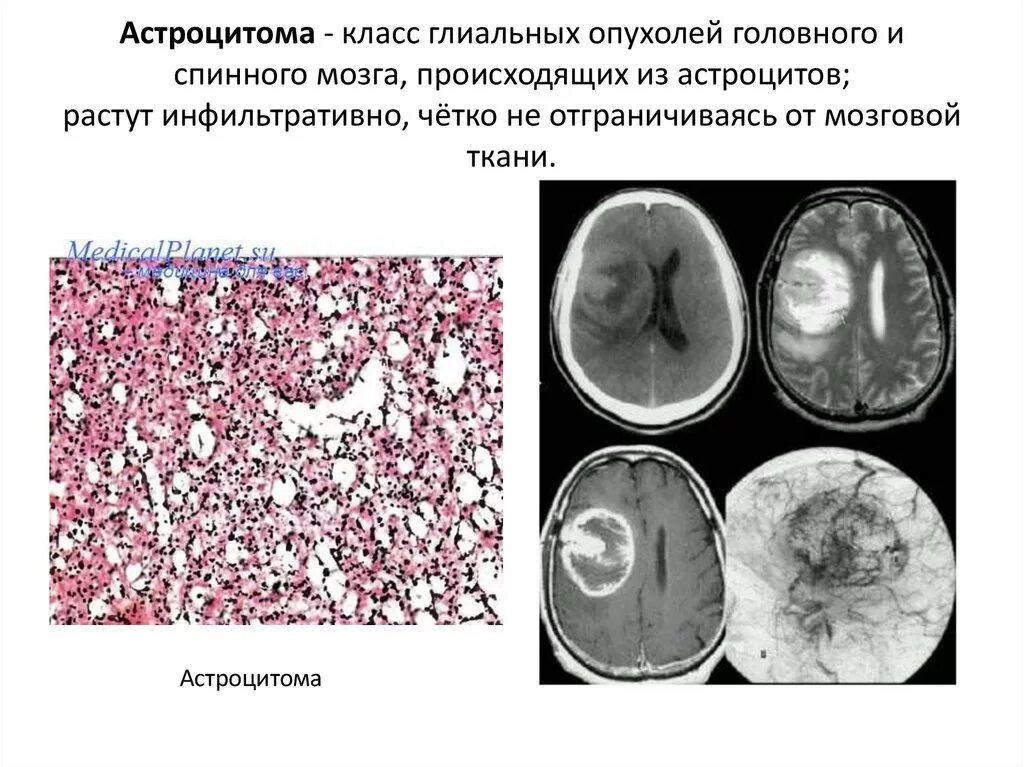 Анапластическая астроцитома гистология. Глиома головного мозга гистология. Анапластическая астроцитома микропрепарат. Анапластическая астроцитома головного мозга. Глиальная опухоль головного