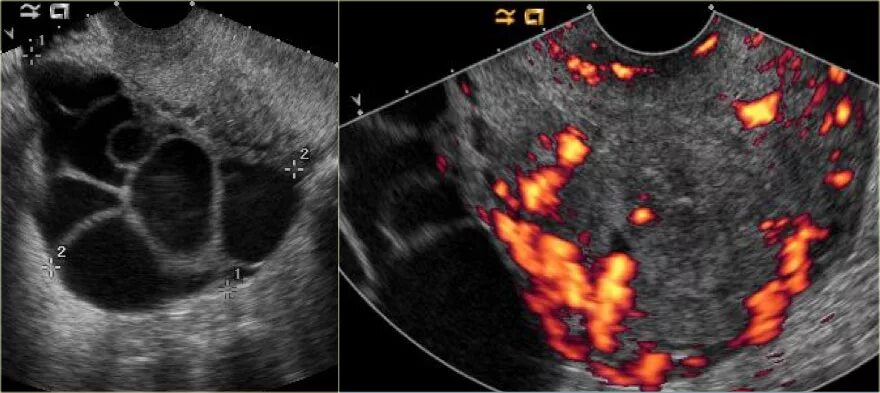 Функционирующий яичник. Текалютеиновая киста яичника УЗИ. Эндометриоидная киста на УЗИ. Многокамерная киста яичника на УЗИ. Текалютеиновая киста на УЗИ.