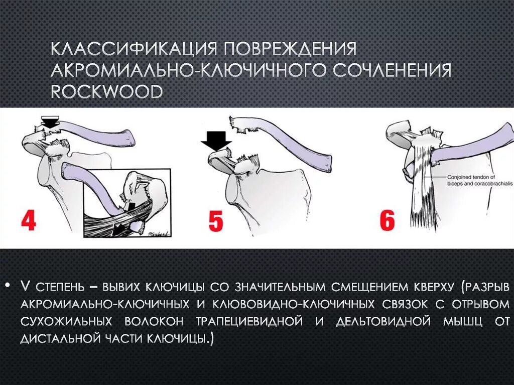 Разрыв сочленений. Повреждение связок акромиально-ключичного сочленения классификация. Степени вывихов ключицы по Роквуд. Разрыв акс плечевого сустава первая степень. Повреждение акромиально-ключичного сустава.