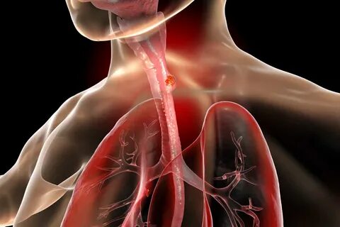 Esophageal cancer