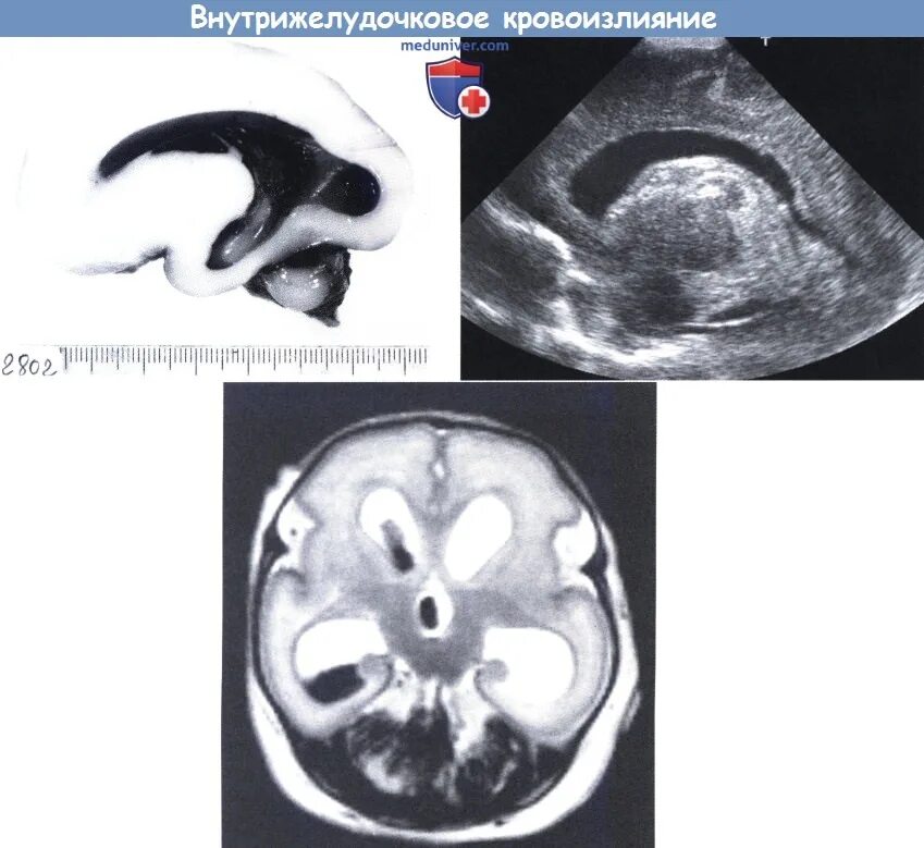 Недоношенный кровоизлияние. ВЖК 4 степени у новорожденных. Герминальный Матрикс. Интравентрикулярное кровоизлияние у новорожденных. ВЖК 3 степени у новорожденных.