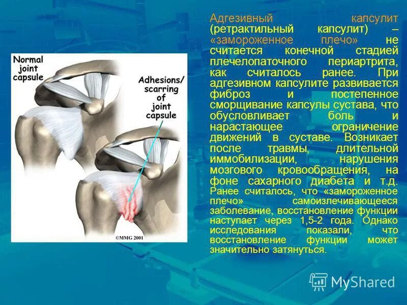 Капсулит симптомы и лечение. Фиброзирующий капсулит. Адгезивный капсулит плеча. Ретрактильный капсулит плечевого сустава. Адгезивный капсулит плечевого сустава рентген.