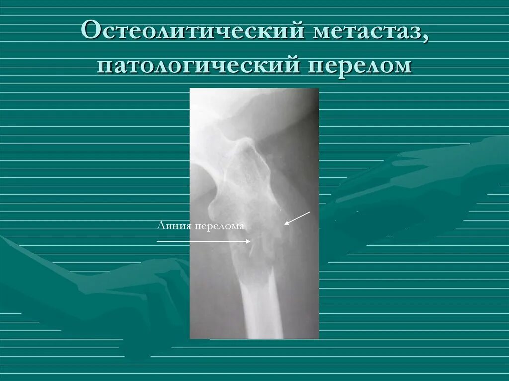 Вторичное поражение костей. Остеолитические метастазы. Остеобластические и остеолитические метастазы в костях. Остеобластические метастазы в костях. Остеолитический метастаз в кости.