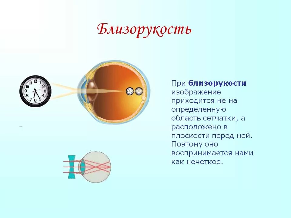 Дальнозоркость это когда. Миопия близорукость глаз. Заболевания органа зрения близорукость и дальнозоркость. Строение глаза при близорукости и дальнозоркости. Нормальное зрение и миопия.